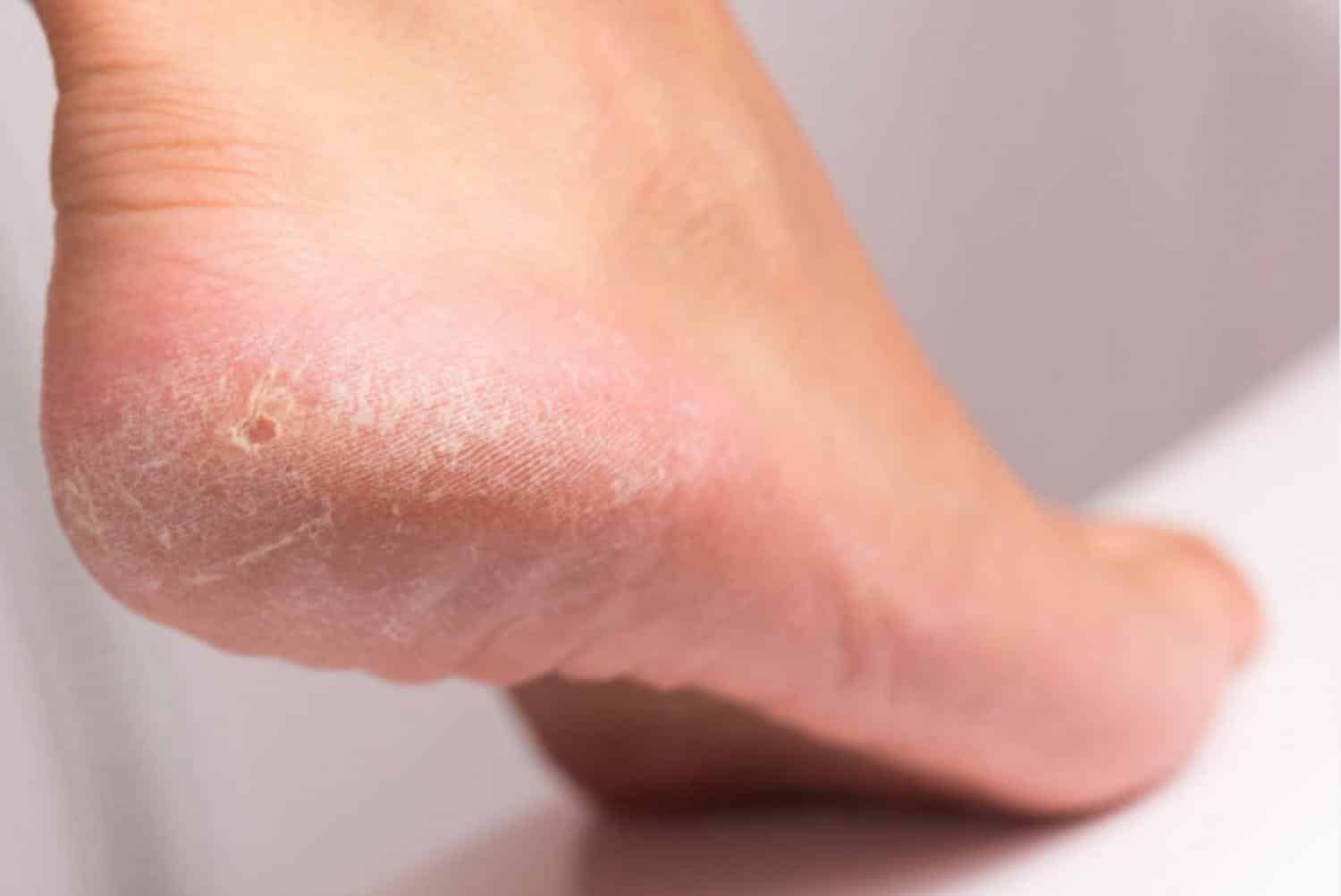 Гиперкератоз стопы: причины и эффективное лечение кожи во время