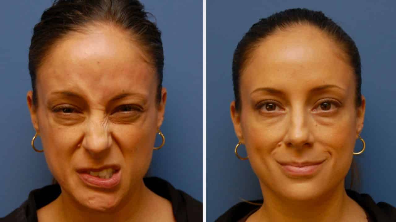 Использование ботокса при повреждении лицевого нерва Слезы     
      Покраснение кожи