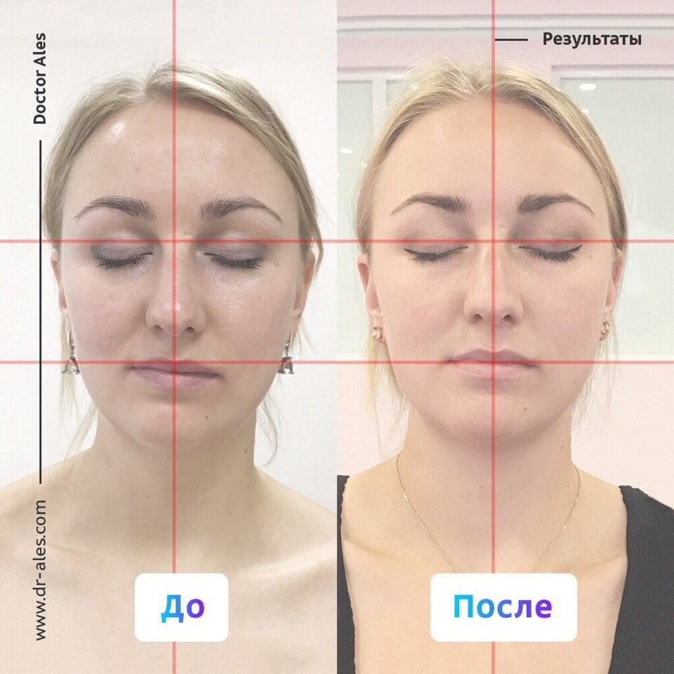 Как исправить асимметрию лица с помощью косметической хирургии Наряду со слабостью лицевых мышц