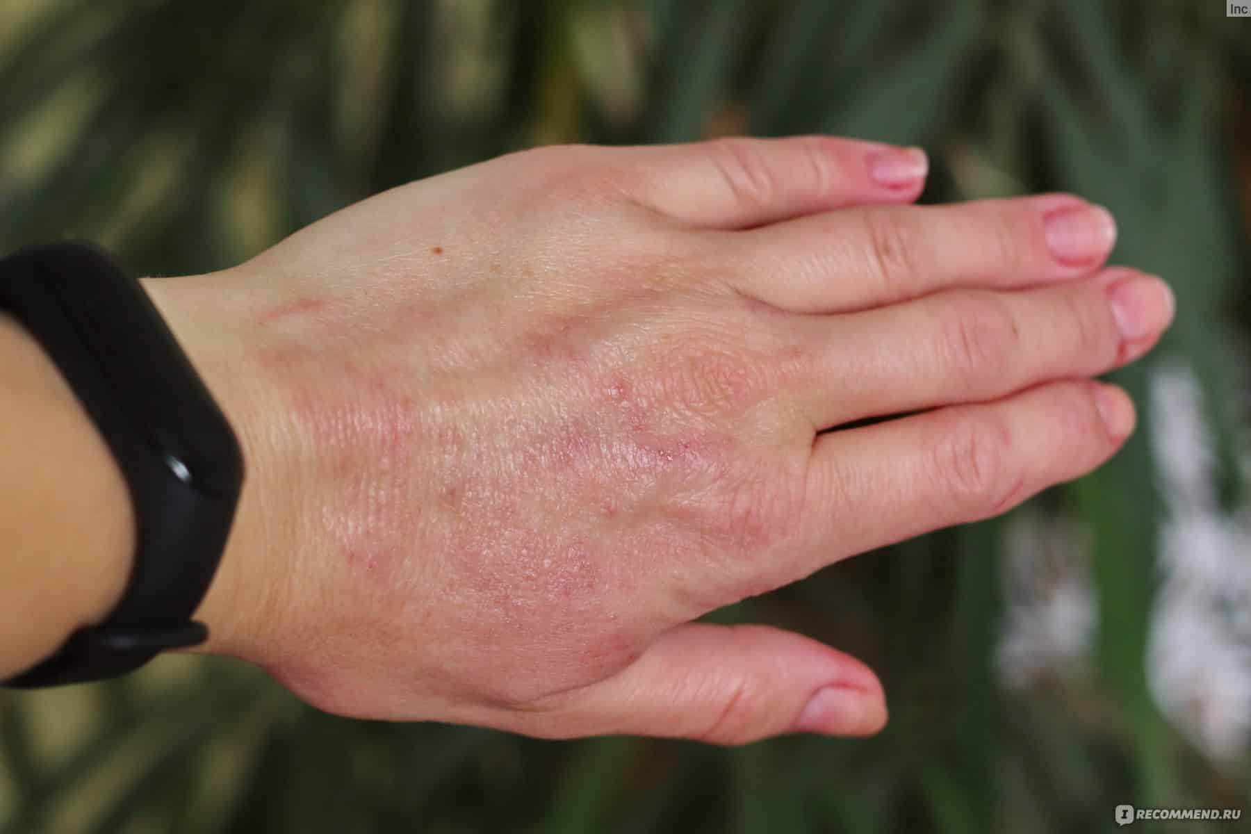 Косметический аллергико-косметический дерматит симптомов аллергических