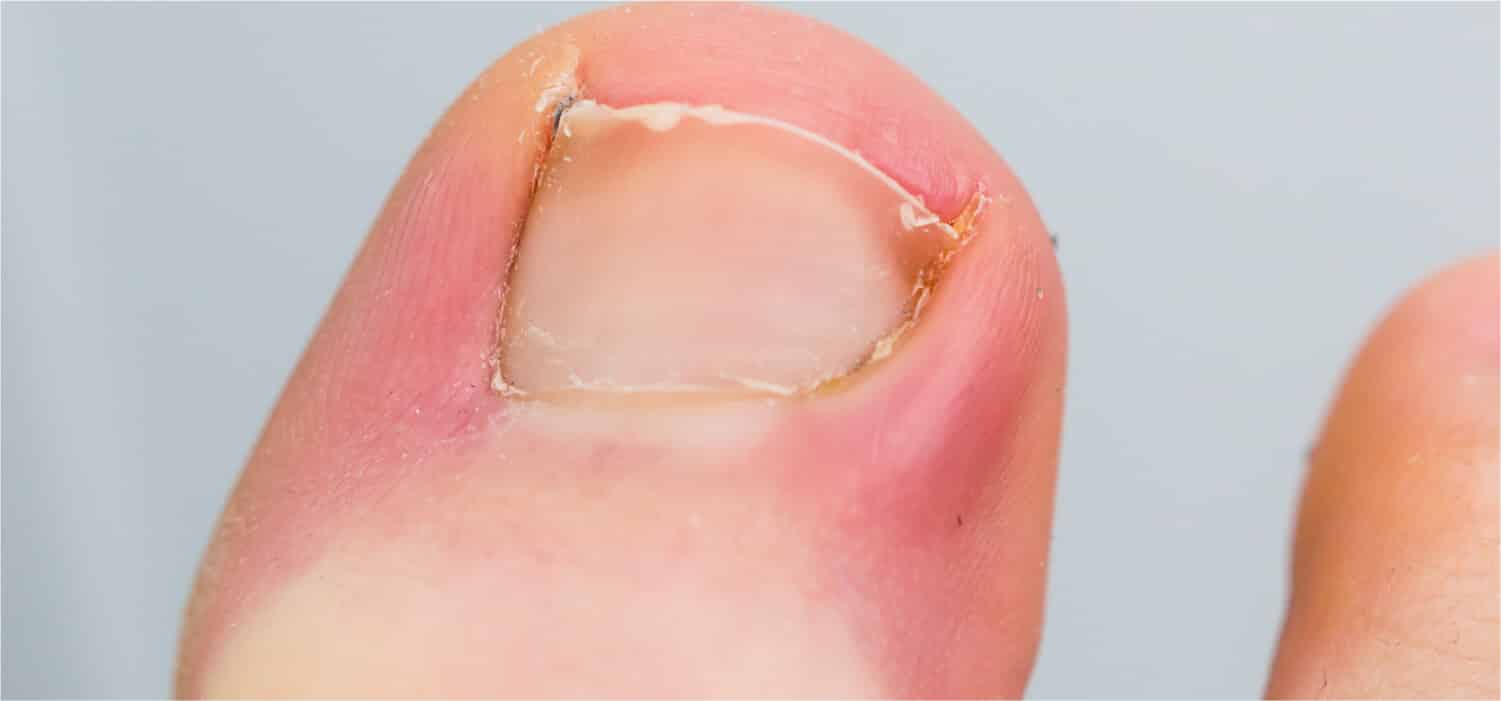 Удаление вросших ногтей и как этого избежать Вросшие ногти на ногах - это