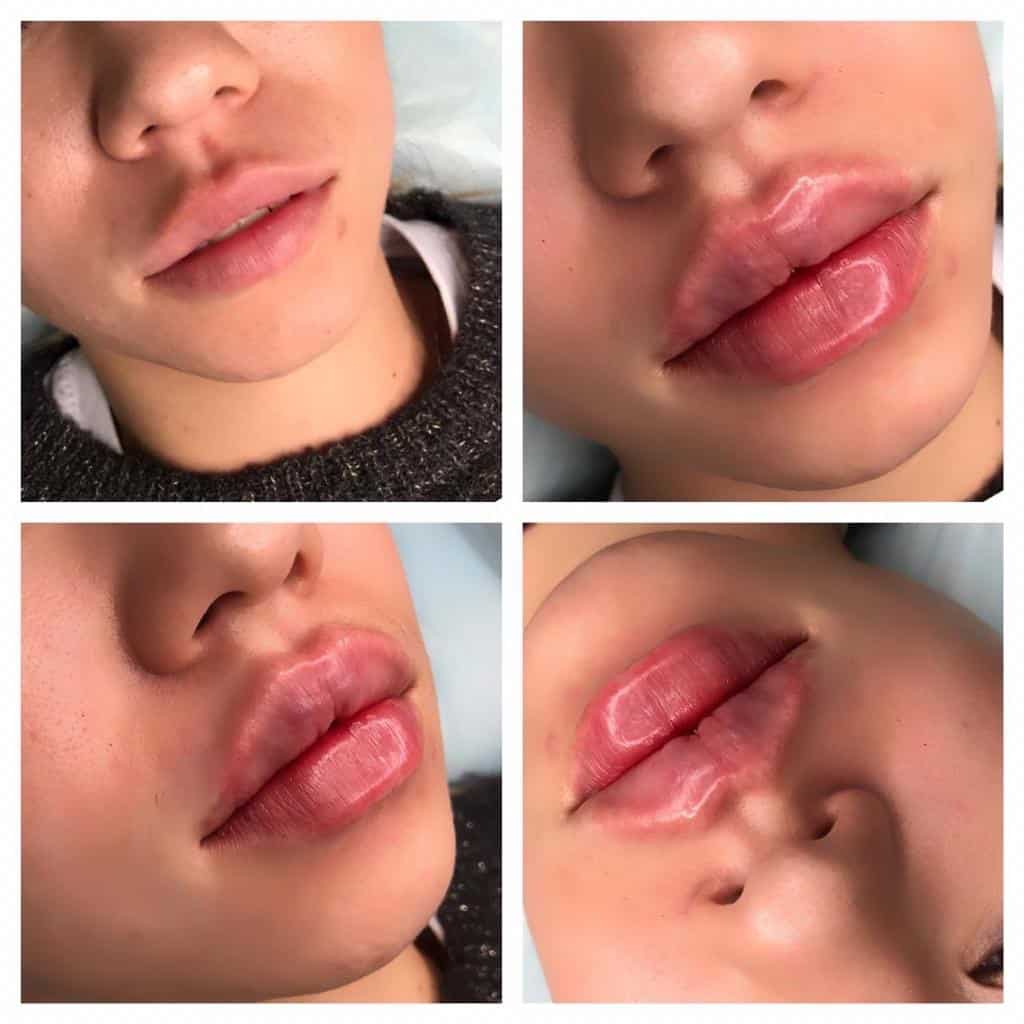 Увеличение губ Биополимерный гель или другие